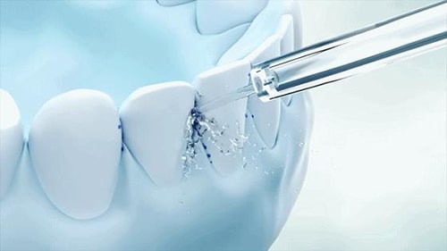 Mga benepisyo ng mga flosser ng tubig para sa mga nagsusuot ng braces